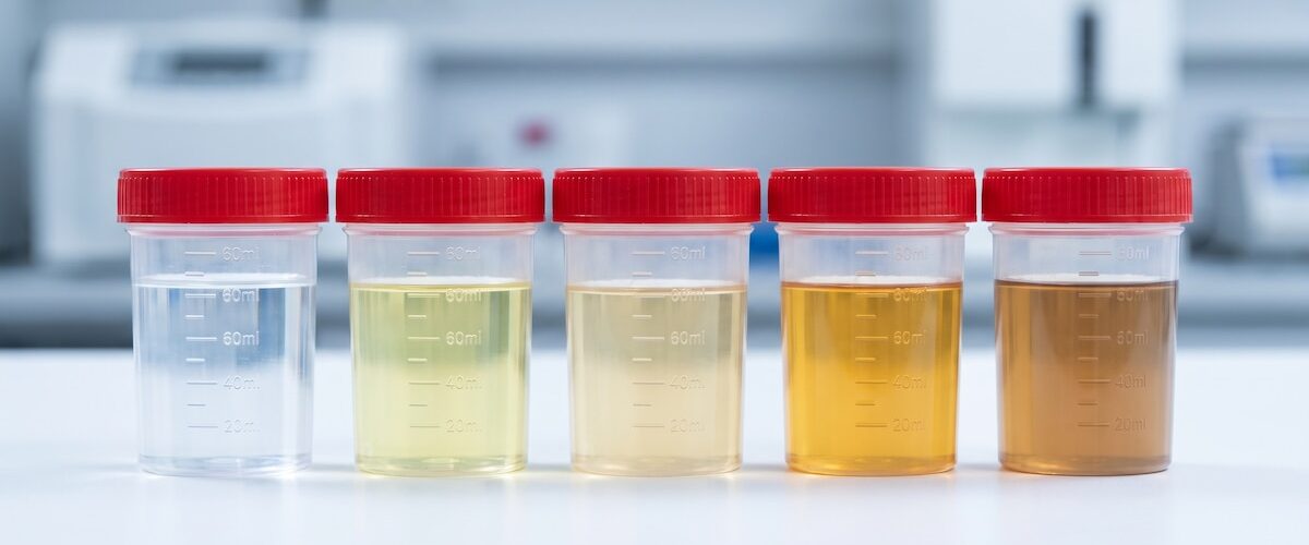 Descubre qué puede indicar el color de la orina sobre tu salud y cuándo consultar a un médico.